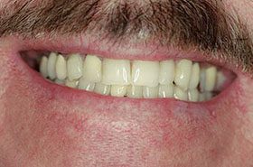 Weaver-Before_Veneers-Crowns-375x230_280wx185h