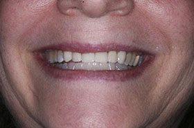 Wehmeyer-Afters_Veneers-Crowns-375x230_280wx185h