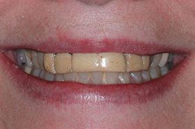 Wehmeyer-Before-2_Veneers-Crowns-375x230_280wx185h