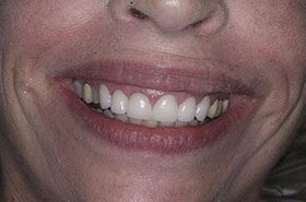 Werling-Afters_Veneers-Crowns-375x230_280wx185h