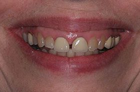 Werling-Before_Veneers-Crowns-375x230_280wx185h