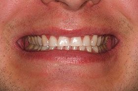 Whitley-After_Whitening-375x230_280wx185h