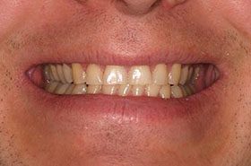 Whitley-Before_Whitening-375x230_280wx185h