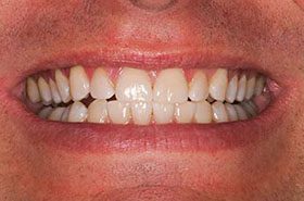 Whitten-After_Whitening-375x230_280wx185h