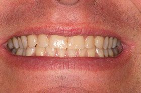 Whitten-Before_Whitening-375x230_280wx185h