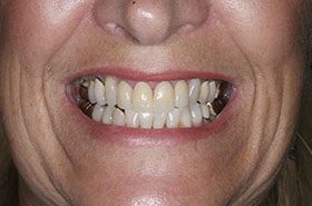Wishard-After_Veneers-Crowns-375x230_280wx185h