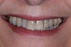Wishard-Before_Veneers-Crowns-375x230_280wx185h