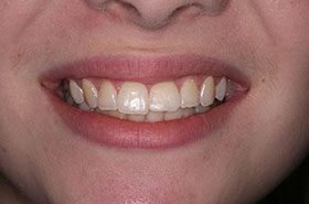 mcGregor-Before_Bonding-375x230_280wx185h