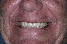 puihls-Afters_Veneers-Crowns-375x230_280wx185h